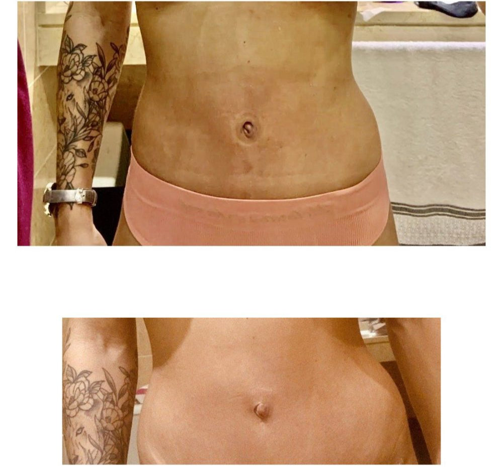 CONFORMADOR UMBILICAL CONICO FORMADOR DE OMBLIGO POSTABDOMINOPLASTIA